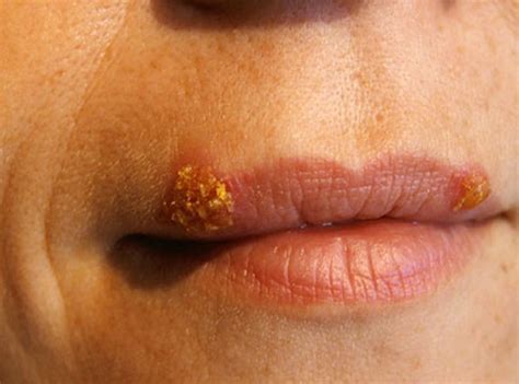Cold Sores On Lips Pictures Causes Treatment Home Remedies Prevention