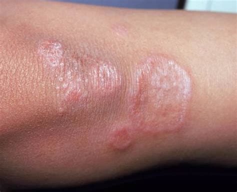 Granuloma Annulare Causes Rash Treatment