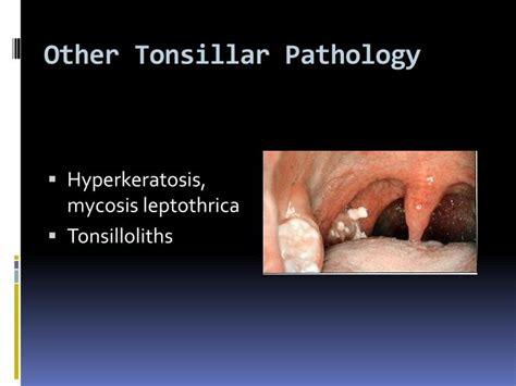 Ppt Tonsillectomy And Adenoidectomy Powerpoint Presentation Id3793355