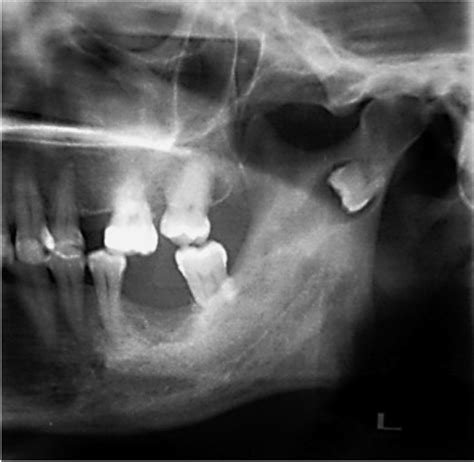 Panoramic Radiograph Showing An Inverted Third Molar Associated With A