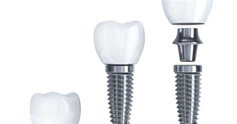 Dental Implant Faqs Your Questions Answered Ddi Dorset