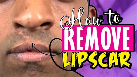 How To Remove Lip Scar Improve Shape And Make In More Luscious