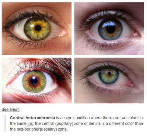 Central Heterochromia Eye Color Facts Eye Color Heterochromia