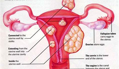 Fibroid Size Chart In Mm