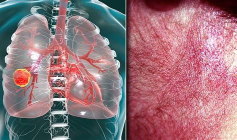 Lung Cancer Warning The Itchy Rash You Shouldnt Ignore It Could Be