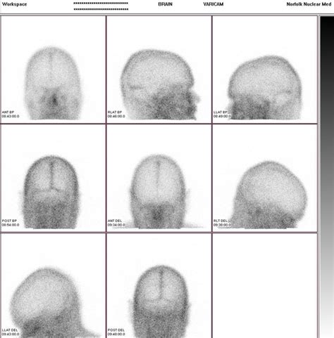 Brain Scintigraphy For Doctors Norfolk Nuclear Medicine Service