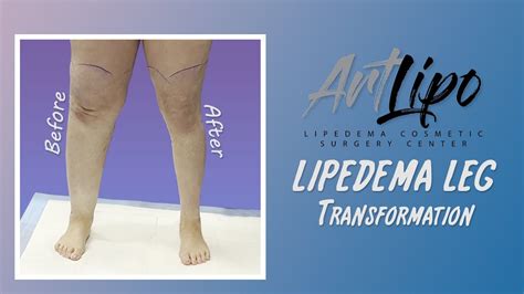 Lipedema Leg Transformation Cankles And Knees Complex Lipo 360