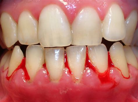 Gingivitis Qué Es Y Cómo Evitarla Clínica Dental Lorenzo