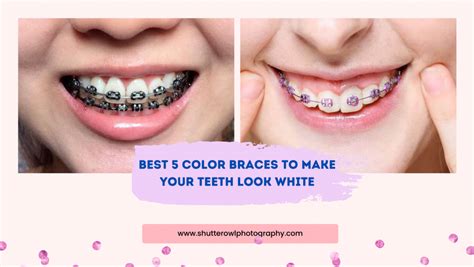 Best 5 Color Braces To Make Your Teeth Look White