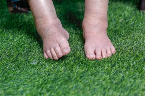 5 Reasons Why You Have Swollen Feet And How To Treat Them Simplyjnj
