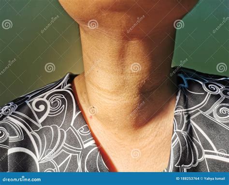 Anterior Neck Swelling Or Goitre In Elderly Asian Lady Stock Photo