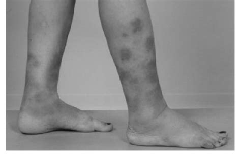 Skin Lesions Suggestive Of Erythema Nodosum On Both Legs Of The Patient