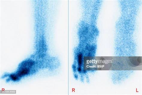 Diabetic Foot Ulcer Photos And Premium High Res Pictures Getty Images