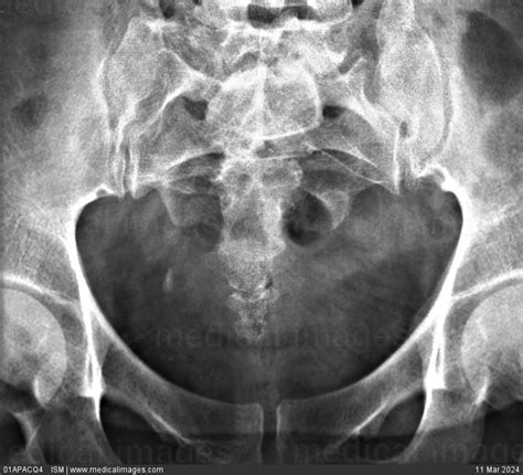 Stock Image X Ray Frontal View Of A Normal Pelvis Showing The Sacrum