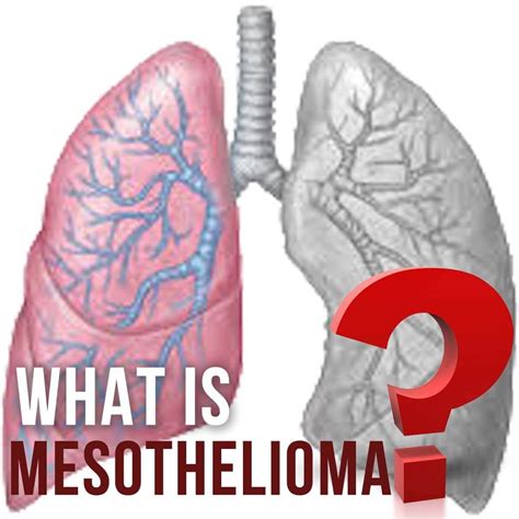 Cancer spreads to nearby organs. What Is Survival Rates Of Mesothelioma | Mesothelioma ...