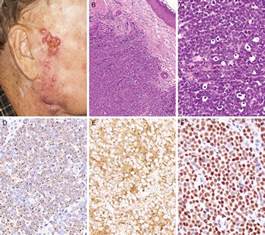 Their shape and color are less distinctive than other skin cancers, and they can often appear as an innocent. Molecular characteristics and potential therapeutic ...
