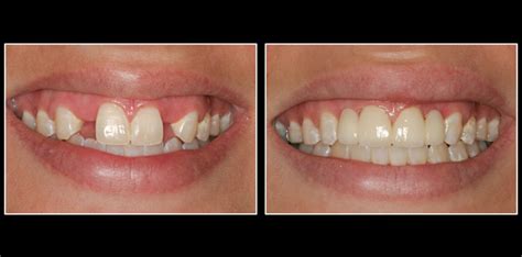 Bridges For Your Teeth Dr Nechupadam Dental Clinic