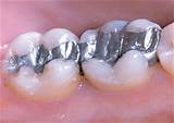 Pictures of Dental Silver Fillings