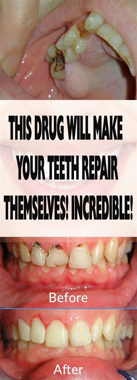 Preventing loose teeth is as simple as practicing good oral hygiene eating healthy and keeping other systemic disease conditions in check. THIS DRUG WILL MAKE YOUR TEETH REPAIR THEMSELVES ...