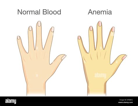 The Difference Of Anemia People Skin And Normal People Stock Vector
