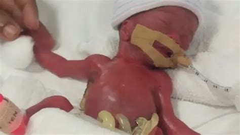 Lahir Prematur Bayi Ini Jadi Paling Ringan Di Dunia Dengan Berat 212
