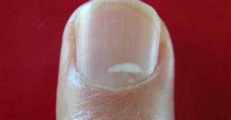 You Have White Spots On Your Nails Here Is What They Warn Us About