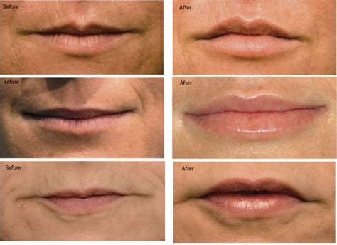13 Best Juvederm Filler Before And After From The Web Images On