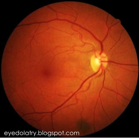 Diagnose My Retinal Photograph Freckles Inside The Eye Eyedolatry