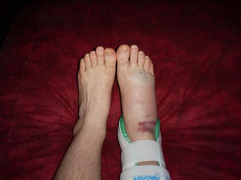 This will be a particular issue for maclin. Sprained my ankle playing basketball bros, what do (reps ...