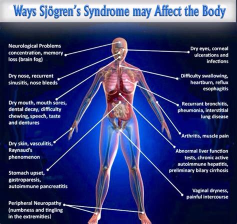Sjogrens Sjogrens Syndrome Sjogrens Disease Symptoms