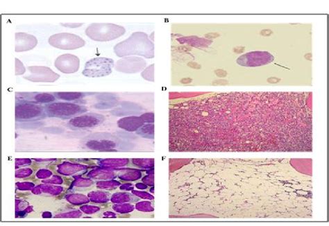 Figure From Etiological And Clinical Spectrum Of Pancytopenia Based