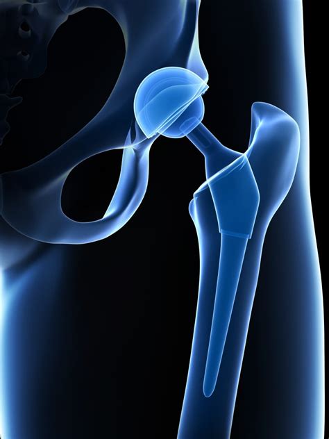 What Is An Anterior Approach Total Hip Replacement Surgery Orlando Orthopaedic Center