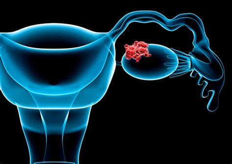 Ovarian Cancer Starts 65 Years Before It Turns Deadly Says New Study
