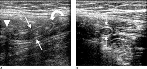 Sonographic Appearance Of The Normal Appendix In Adults Yabunaka