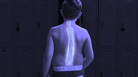 Magec Treating Scoliosis With Magnets Youtube