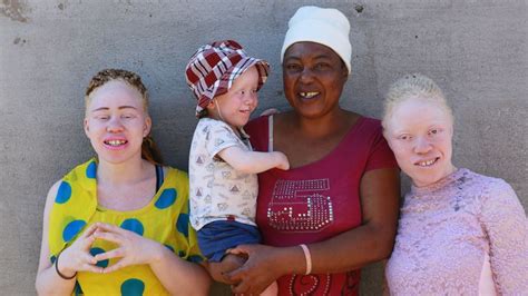 In Zimbabwe People With Albinism Struggle Against Prejudice Abc News