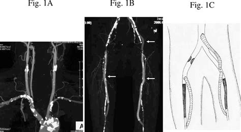 Figure 1 From Carotid Artery Stenting Via A Femoral Bypass Graft