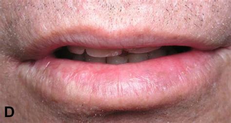 Skin Cancer On Upper Lip