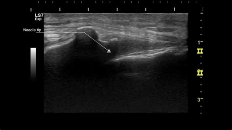 Ultrasound Guided Caudal Epidural Block Youtube