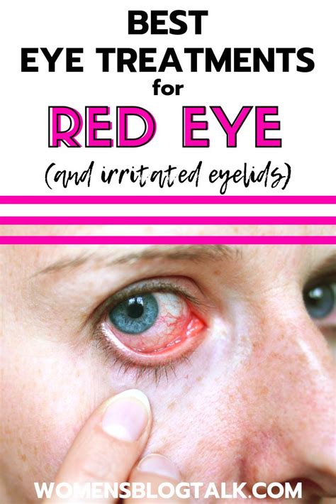 Get Rid Of Red Eye At Home Diy Treatments For Dry Red Eyes And