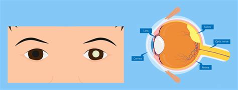 Utah Retinoblastoma Program | John A. Moran Eye Center | University of