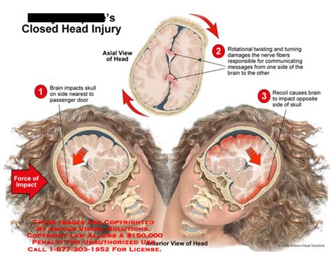 Closed Head Injury