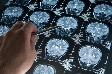 Alzheimera choroba przyczyny i leczenie istotą początkowe objawy rozwój zdjęcia choroby