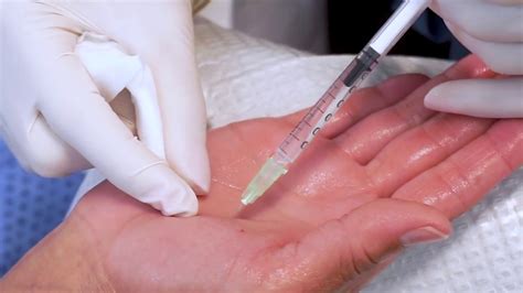 Botox For Excessively Sweaty Palms Youtube