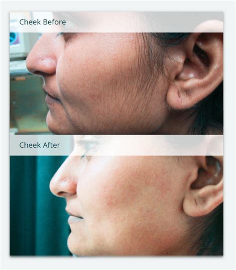 Companies offering laser hair removal near colorado springs, united states. Before & After Photos of Laser Hair Removal | Milan Laser