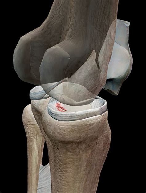 Do The Twist A Look At A Torn Meniscus
