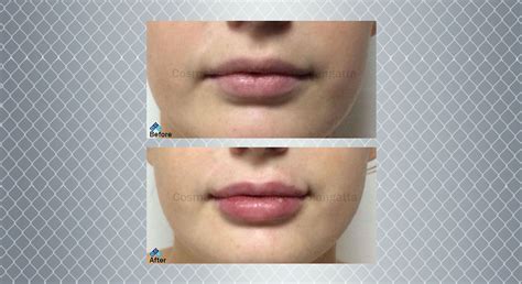 Lip Enhancement Women Lip Fillers And Injections Gold Coast