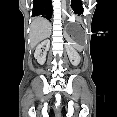 Ct Scan Of The Abdomen Showing Splenic Abscess Which Has Ruptured With