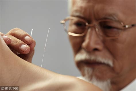 Precious Legacy Of Traditional Chinese Medicine Acupuncture And Moxibustion Cgtn