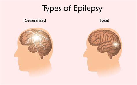 Brightmindsbio On Notepd Epilepsy Causes Symptoms D